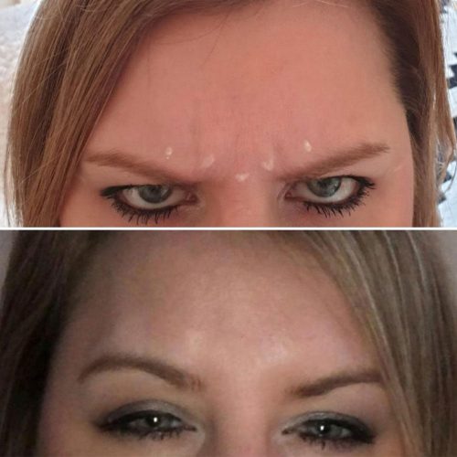 Before and after anti-wrinkle treatment for frown lines.