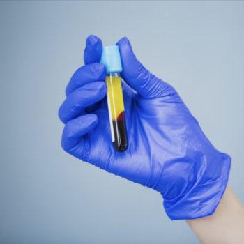 Platelet rich plasma test tube sample
