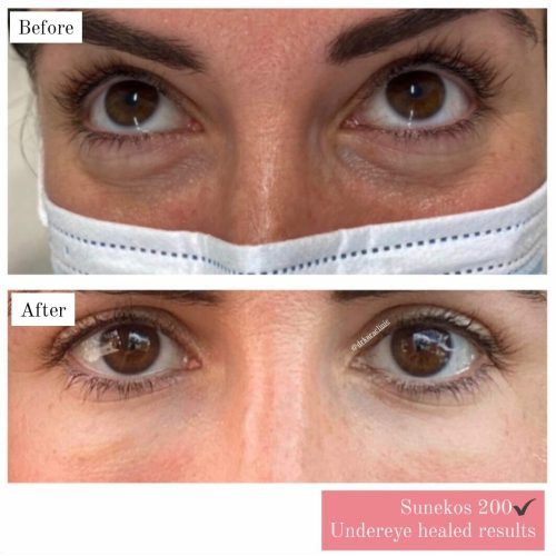 sunekos eye Sunekos skin booster under eye results