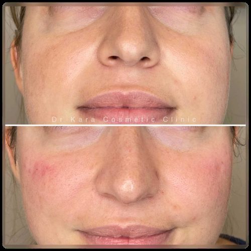 Tear trough dermal filler result by Dr Kara Cosmetic Clinic , Norwich , Norfolk