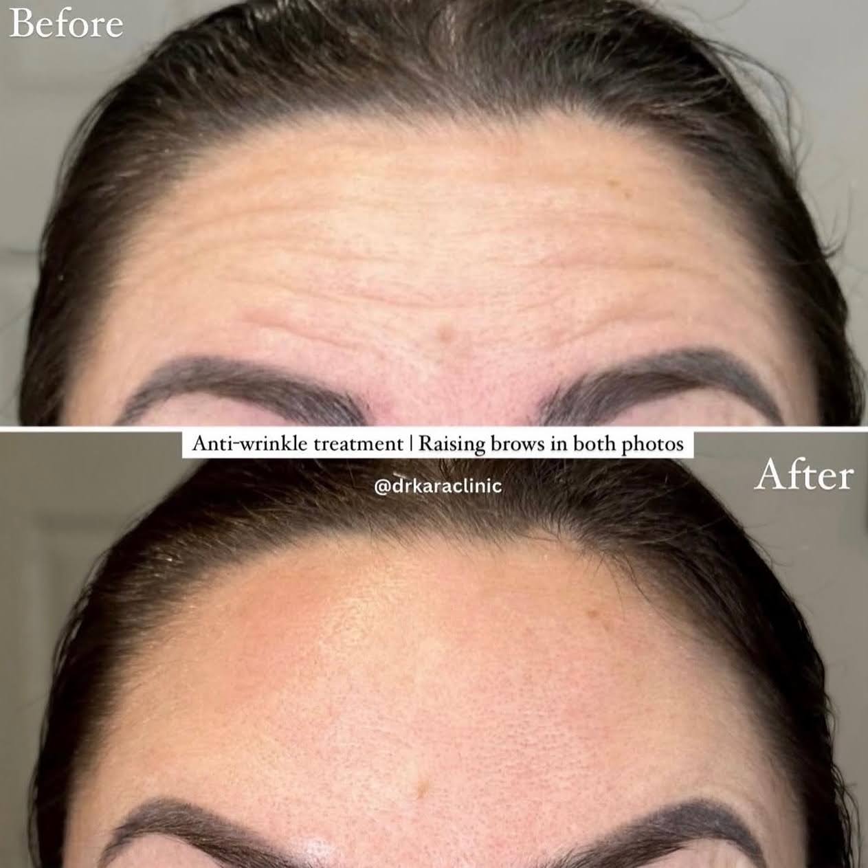 forehead botox result