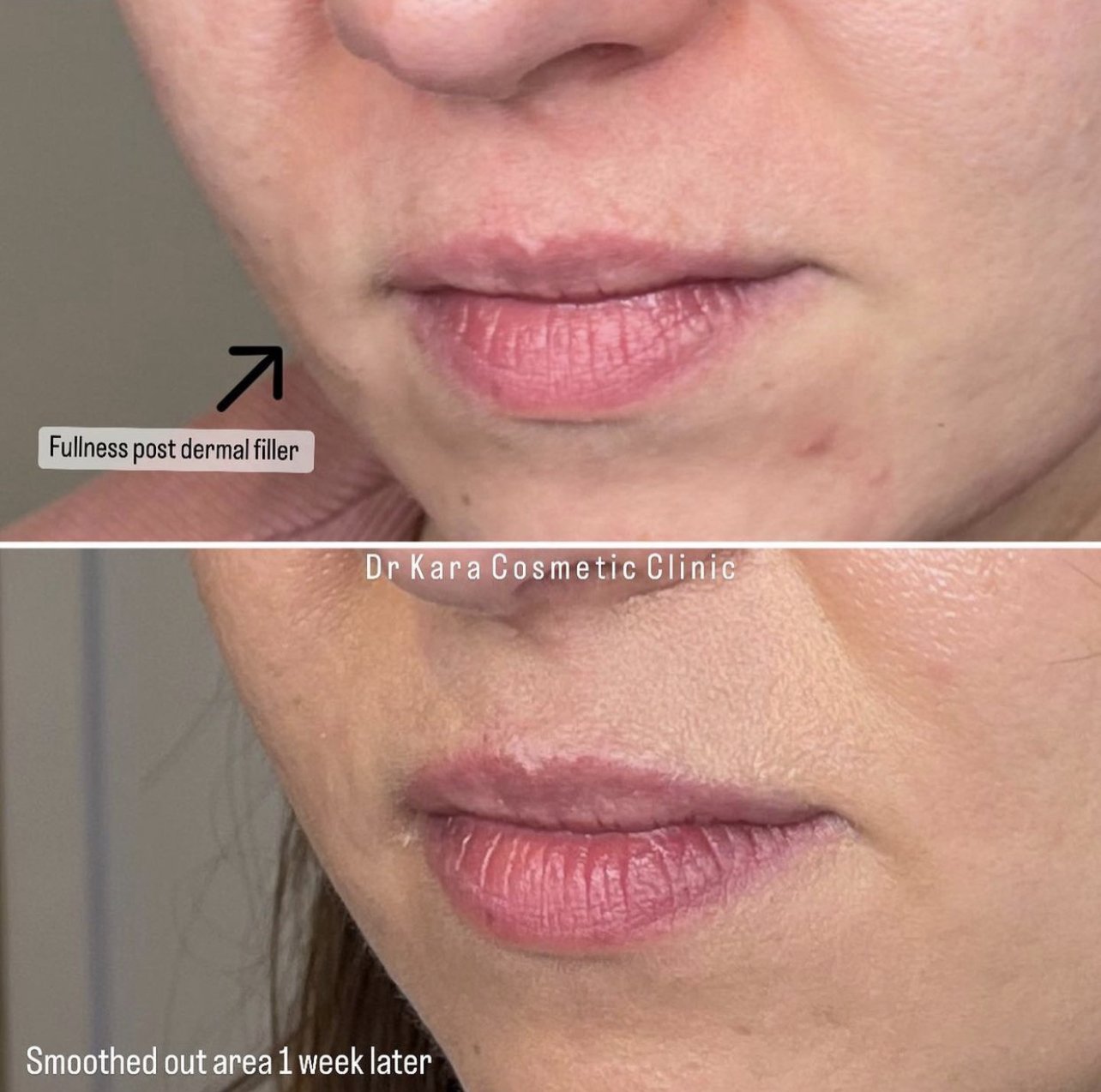 Topilase result by Dr Kara Cosmetic Clinic, Norwich,Norfolk