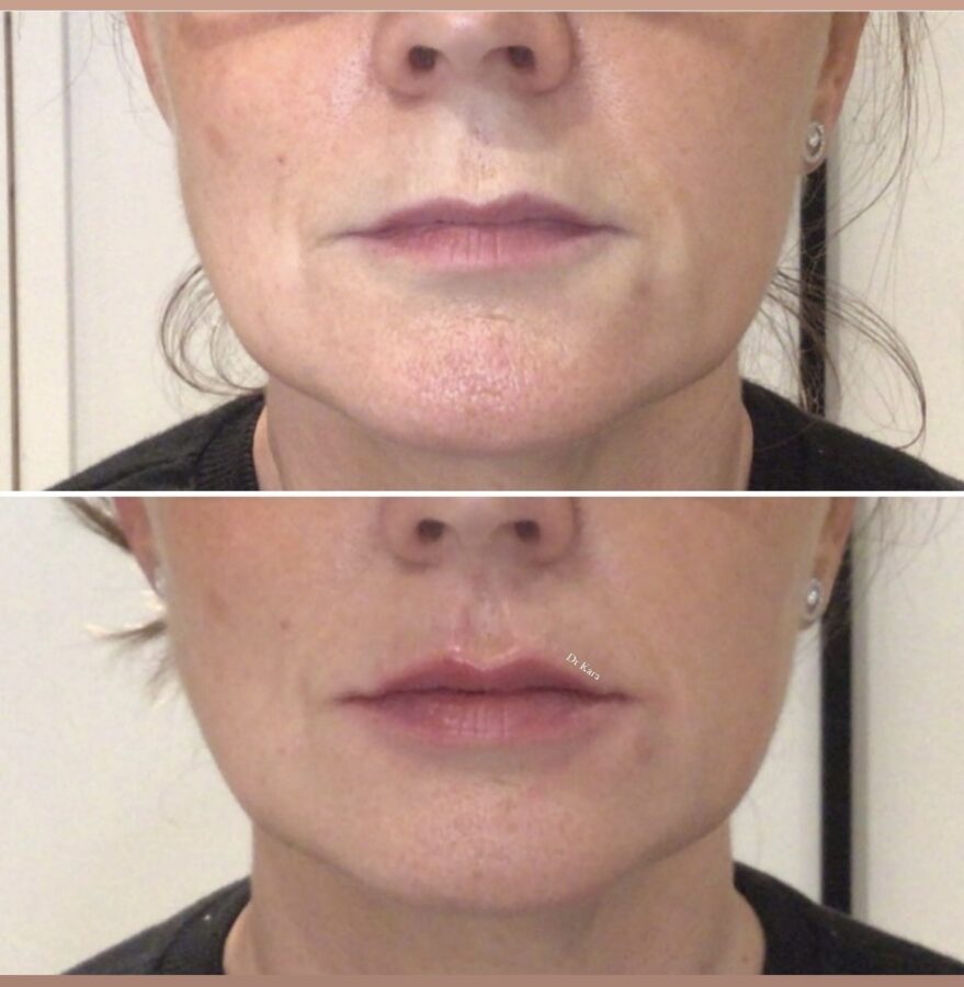 Lip Filler Dr Kara Cosmetic Clinic Norwich Aesthetics