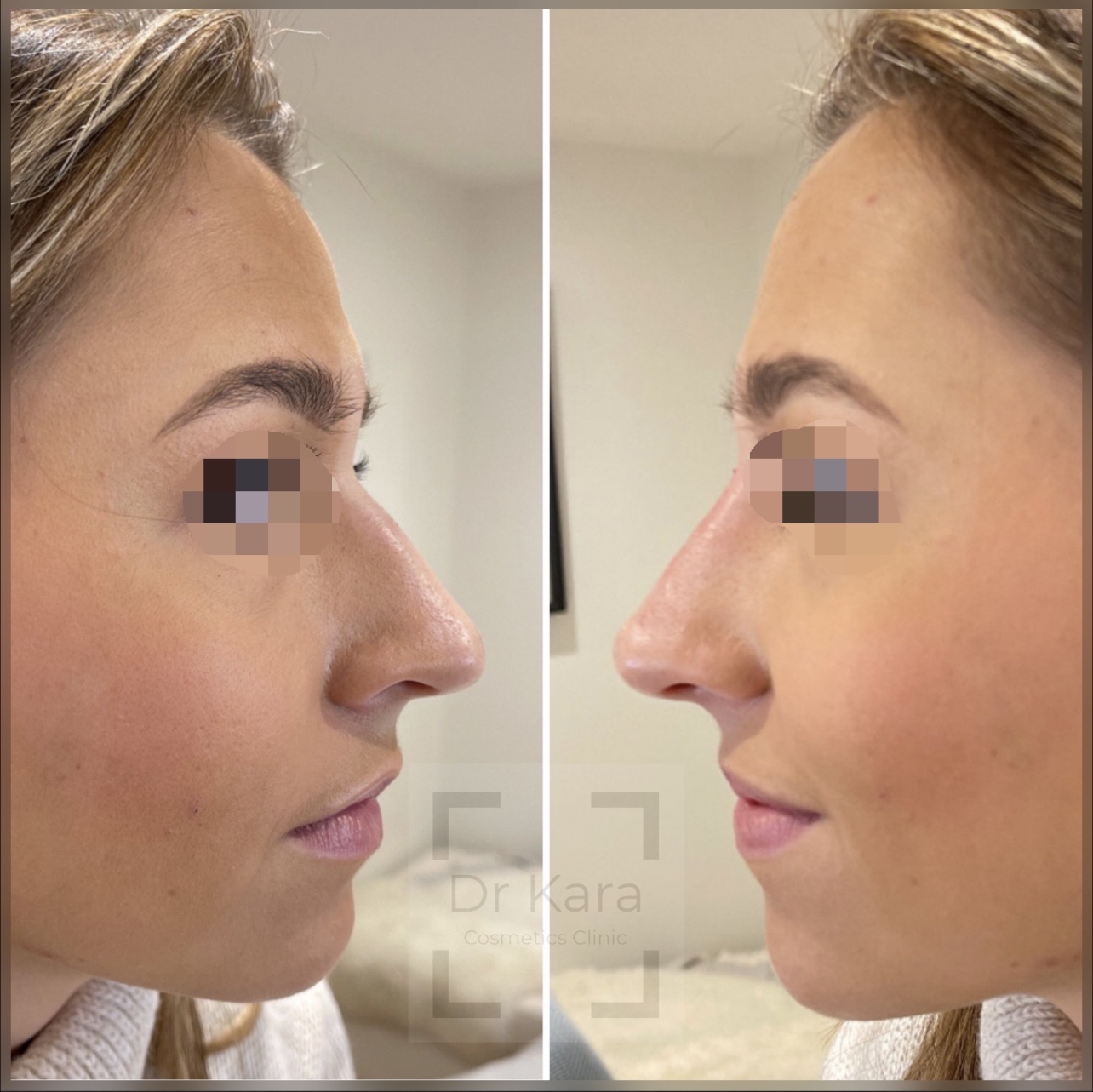 Non surgical rhinoplasty / Nose dermal filler result before and after by Dr Kara Cosmetic Clinic , Norwich , Norfolk , UK