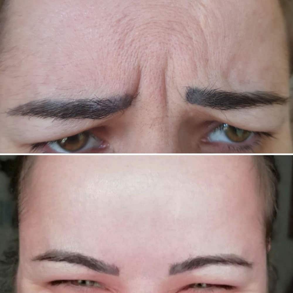 Frown / Glabellar botox before and after photo by Dr Kara Cosmetic Clinic