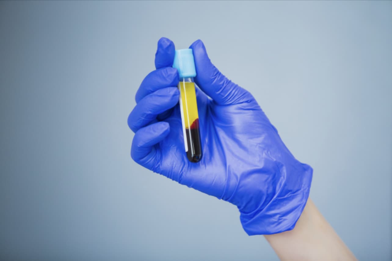 Platelet rich plasma test tube sample