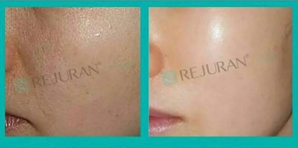rejuran face