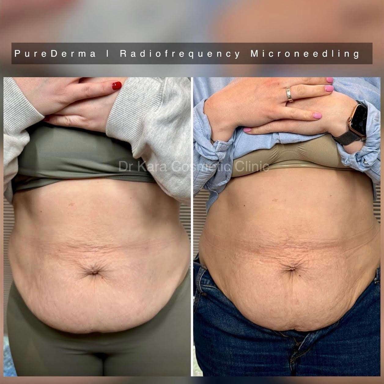 Radiofrequency microneedling body abdomen result in Norwich,Norfolk, UK by PureDerma
