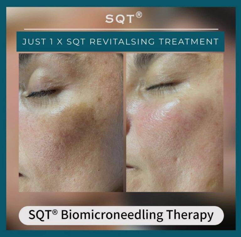 Treatments 17 Before and after cheek photos from an SQT Biomicroneedling Therapy treatment