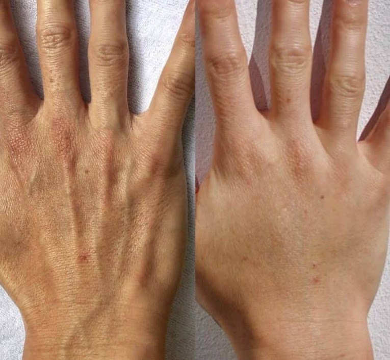 Hand profhilo