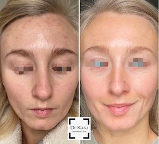 Before and after Obagi skincare result by Dr Kara Cosmetic Clinic, Norwich , Norfolk