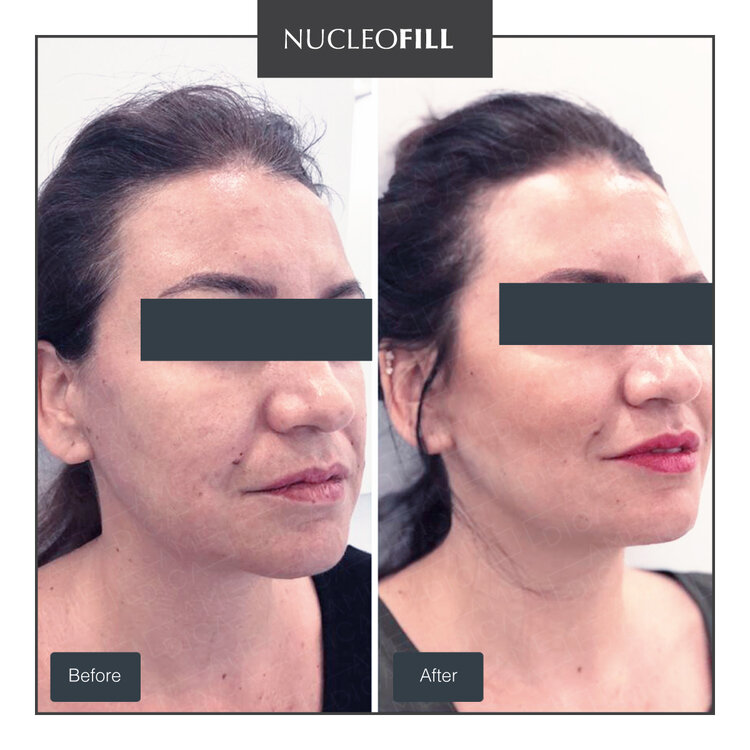 Nucleofill face result