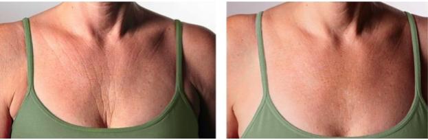 Profhilo Galway Chest Wrinkles