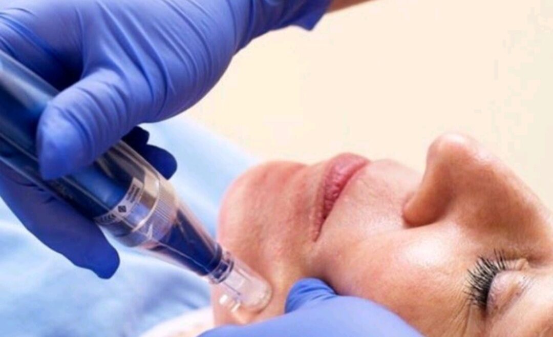 MIcroneedling skin with SkinPen device norwich norfolk