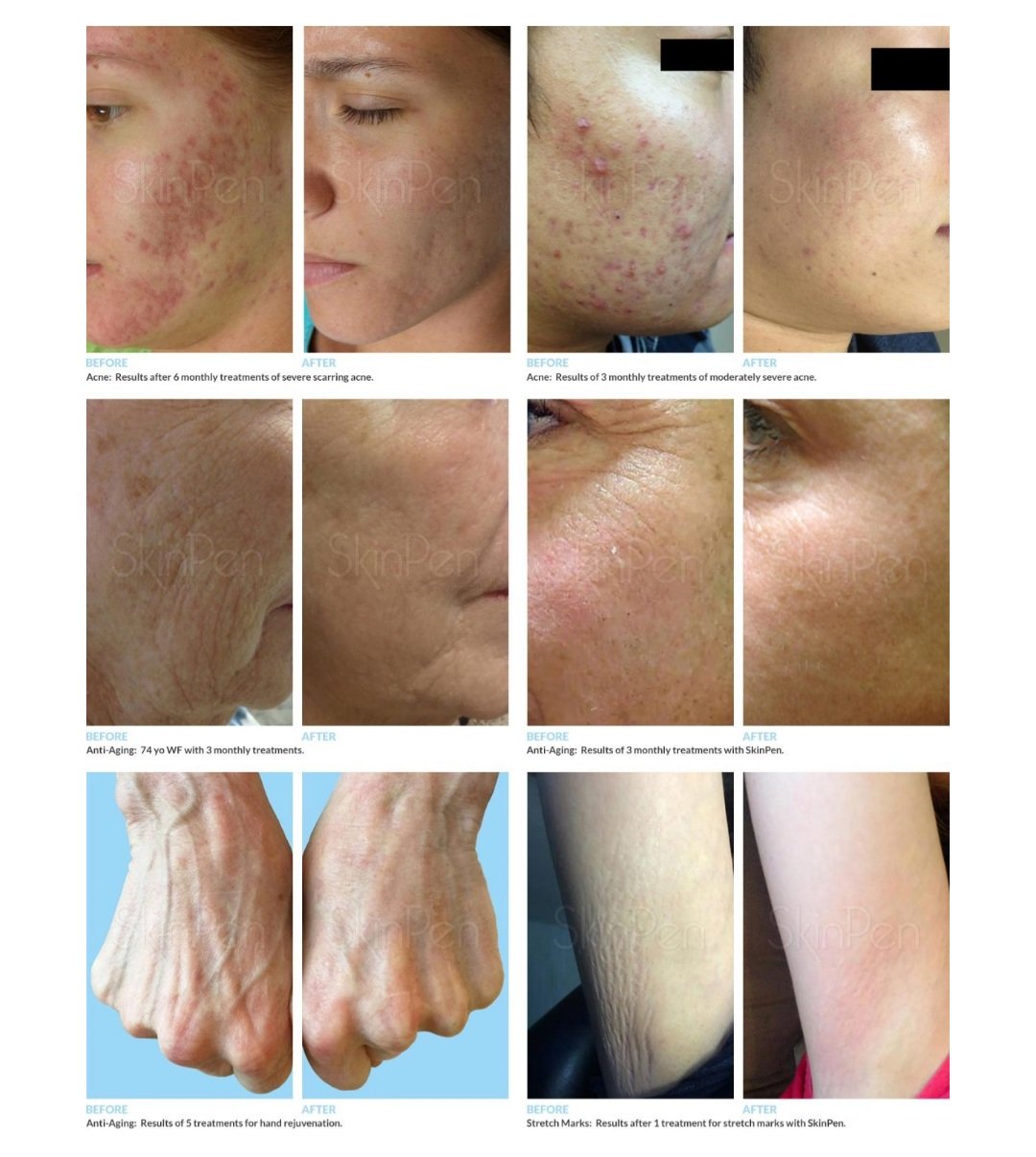 Skinpen results