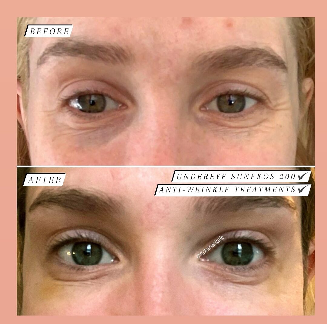 Botox / anti-wrinkle treatment Chemical brow lift by Dr Kara Cosmetic Clinic + Skin booster Sunekos 200 treatment
