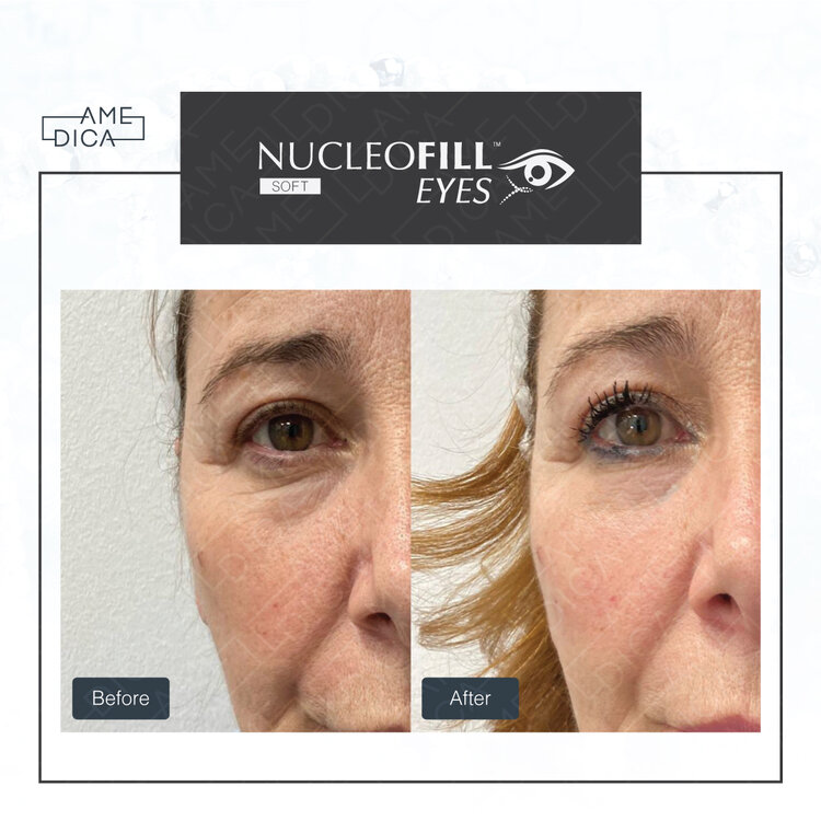 Nucleofill eyes result